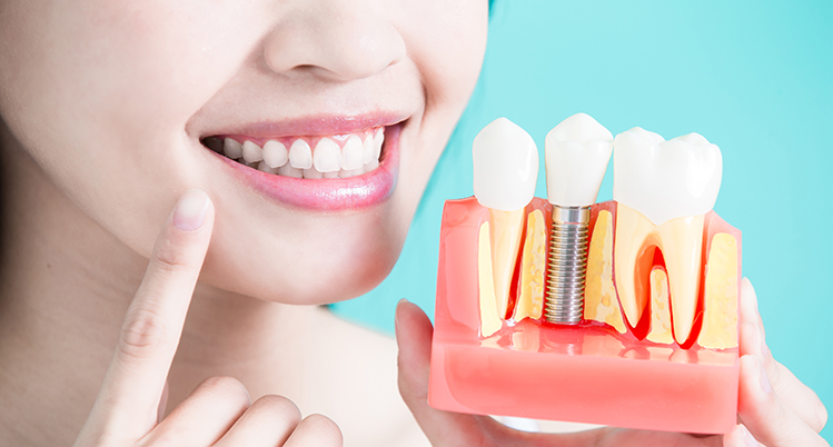 インプラントの模型を持つ女性