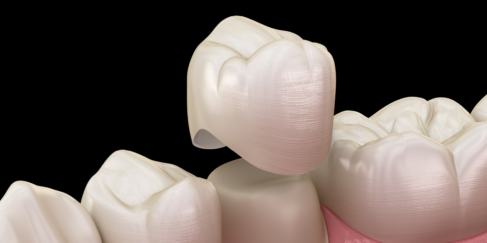 クラウンを歯に装着するイメージ