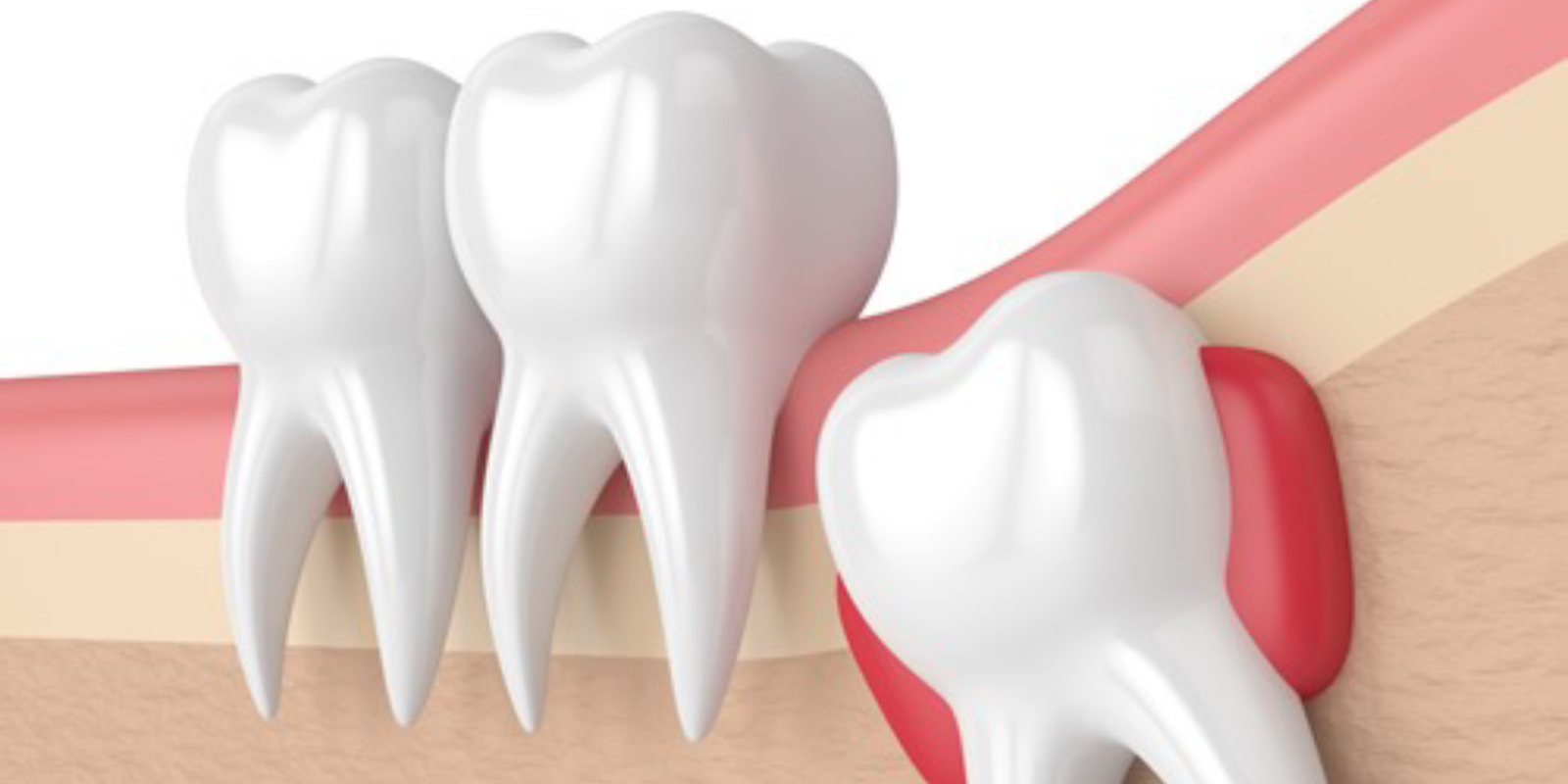 埋まっている親知らずのイメージ