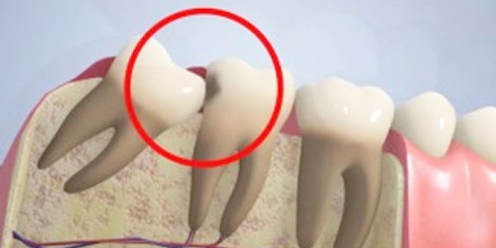 親知らずが手前の歯にぶつかって生えているために、手前の歯が虫歯になってしまっているイメージ