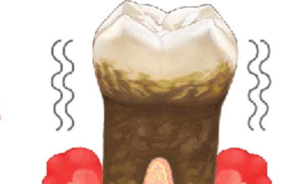 歯周病により揺れが強くなってしまった歯のイメージイラスト