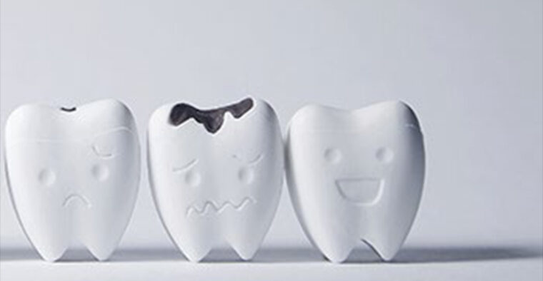 右が健康な歯・真ん中が虫歯で黒く少し溶けた歯・左が初期虫歯で歯の溝が少し黒くなっている、３本の歯の模型が並んだ画像