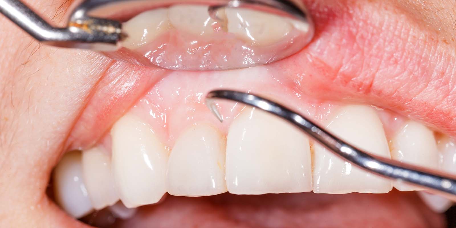 歯ぐきの状態をチェックされているイメージ