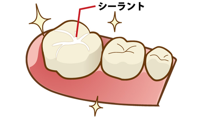奥歯にある溝にシーラントと呼ばれる虫歯予防の材料を詰めたイラスト