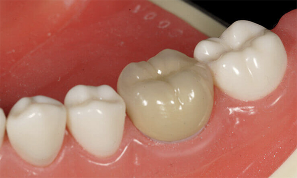 東松原歯科のメタルボンド