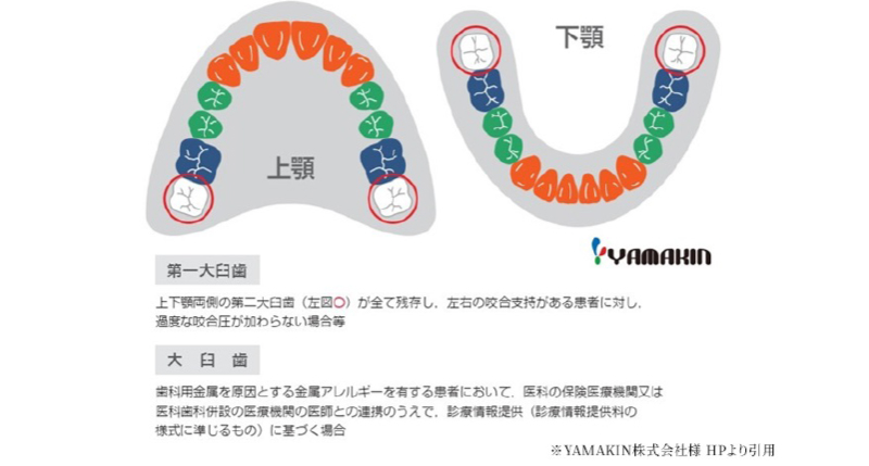 CADCAM冠適用部位についての画像