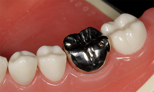 東松原歯科のシルバークラウン