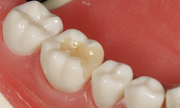 東松原歯科のオールセラミックインレー