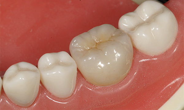 東松原歯科のジルコニアステイン