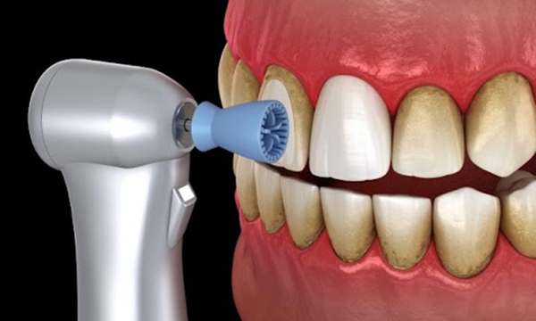 着色で汚れている歯をラバーカップという機械で歯を綺麗に磨くイメージイラスト