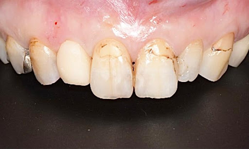 レジンという素材を詰めて治療している歯があり、その部位に経年的な着色が見られる口腔内写真