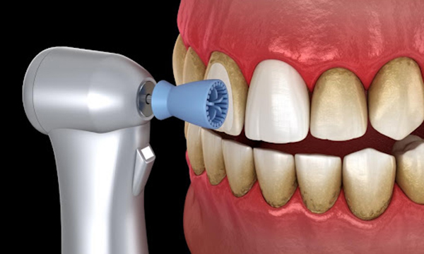 着色で汚れている歯をラバーカップという機械で歯を綺麗に磨くイメージイラスト