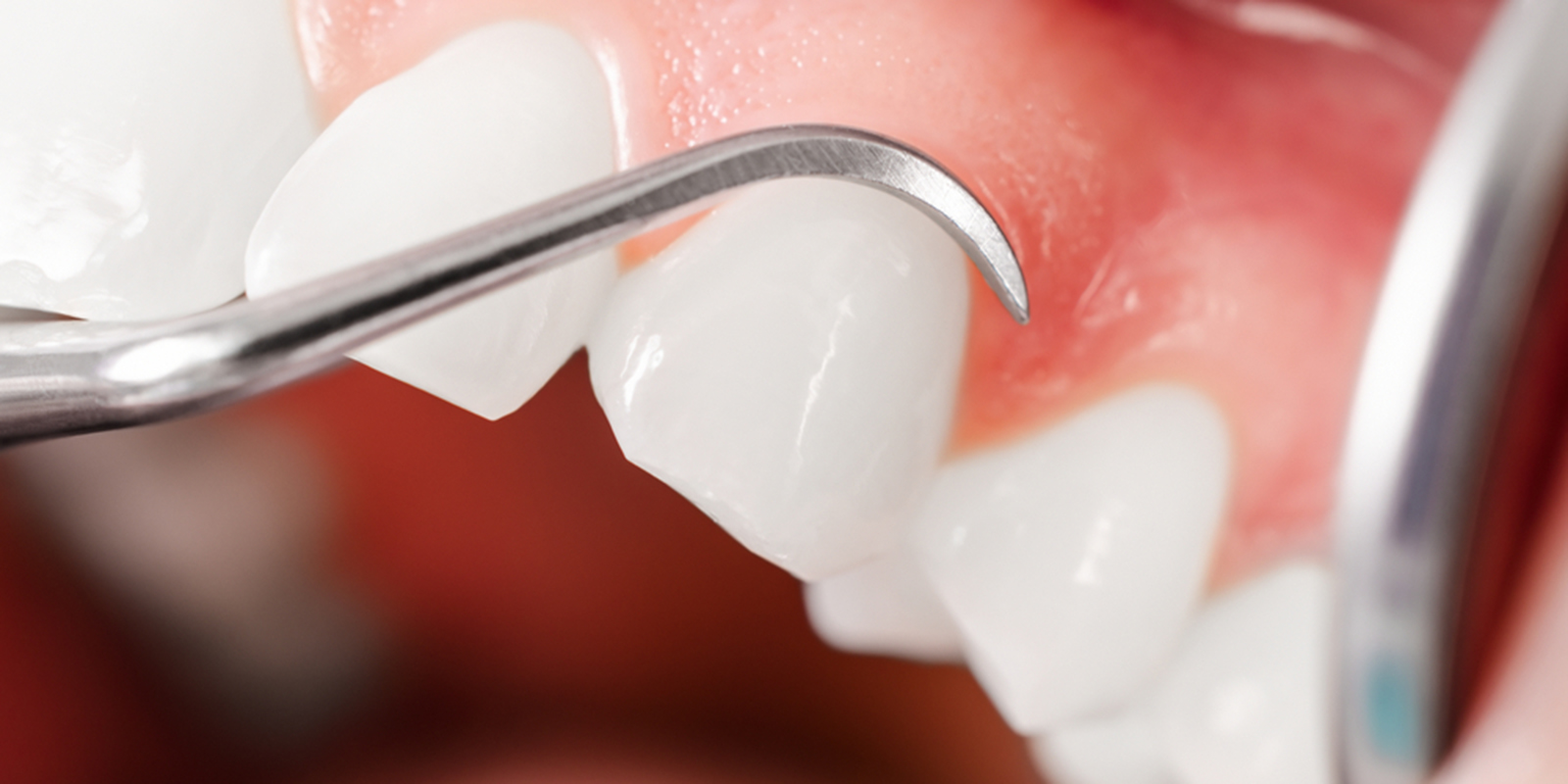 歯ぐきの状態をチェックされているイメージ