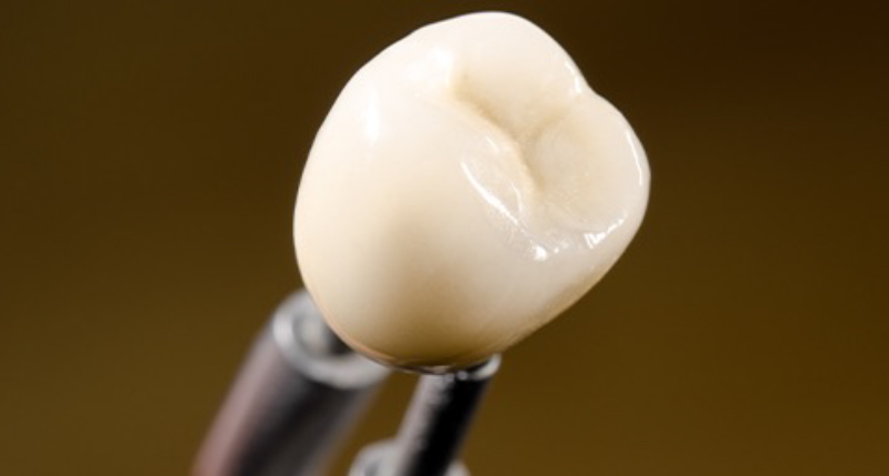 セラミッククラウンの写真