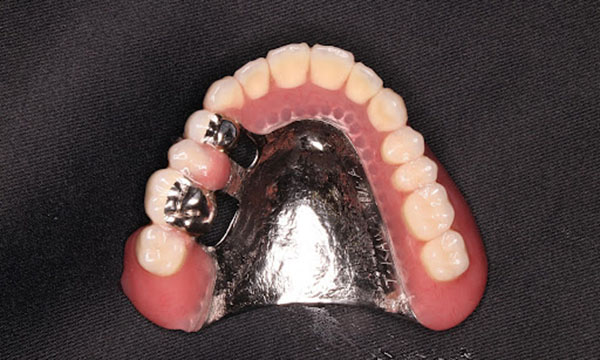 金属を使用した総入れ歯
