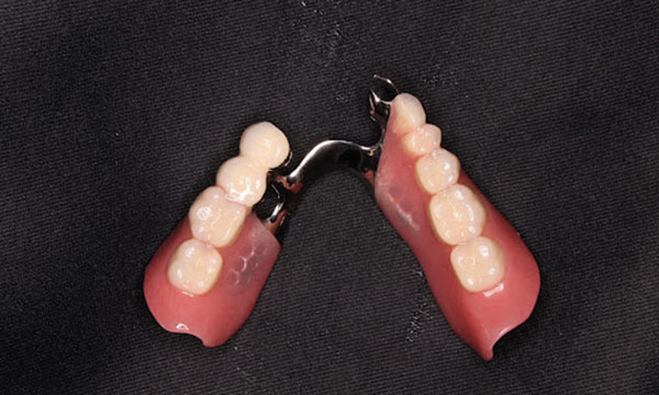 金属を使用した部分入れ歯