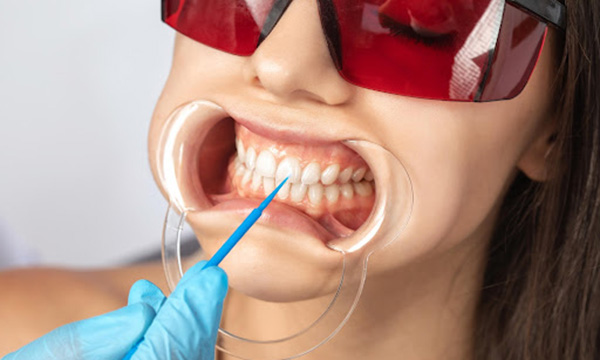 オフィスホワイトニングを受ける女性のイメージ