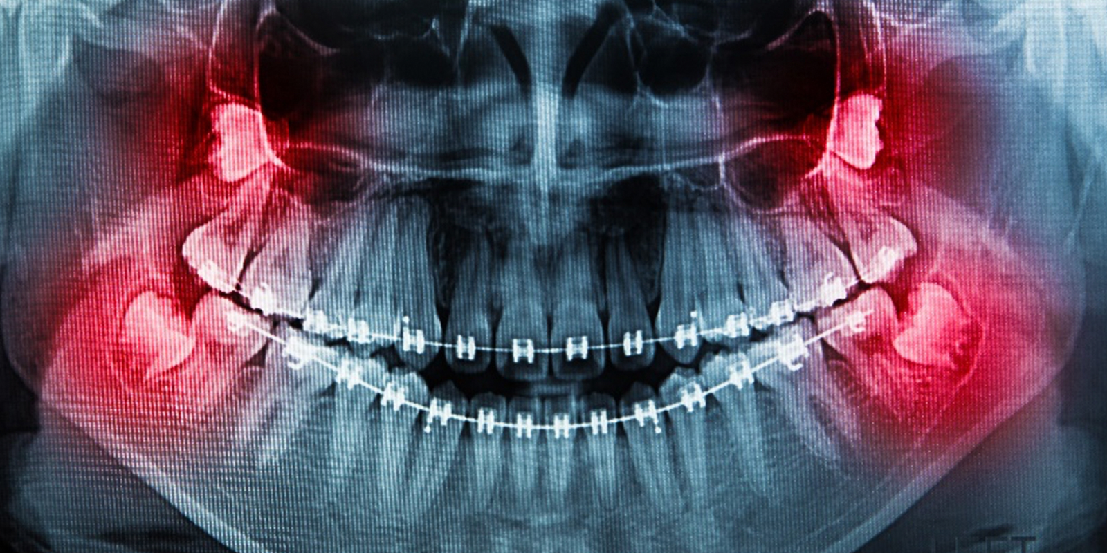 親知らずが上下左右ある方のレントゲン画像