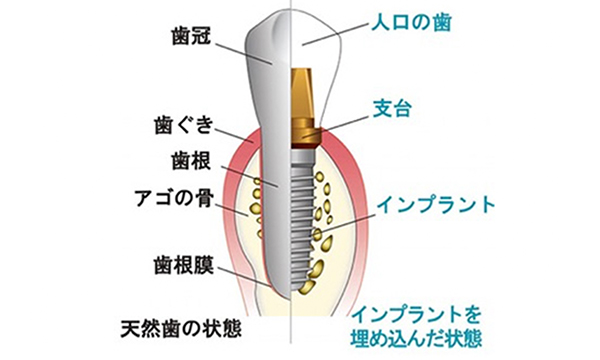 歯の組織とインプラントの構造の断面図のイラスト