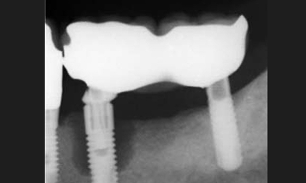 インプラントの歯の部分的なレントゲン写真