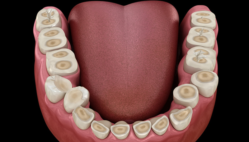 歯ぎしりなどでエナメル質がすり減ってしまい、象牙質が露出しているイメージイラスト
