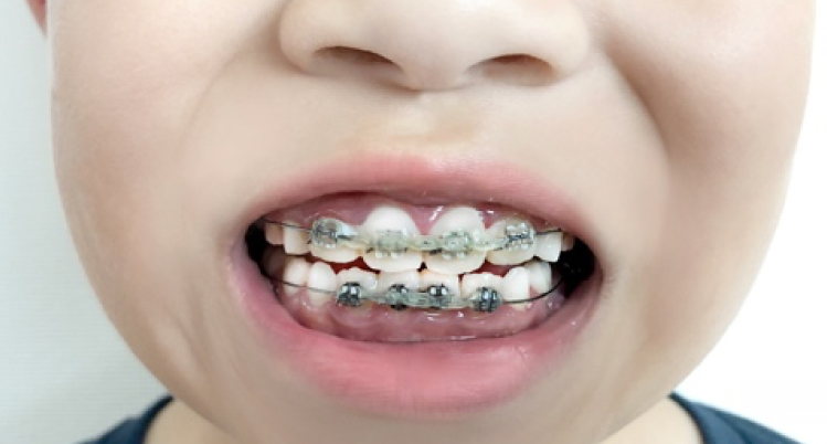 小児の歯列矯正治療の種類と開始時期、費用について