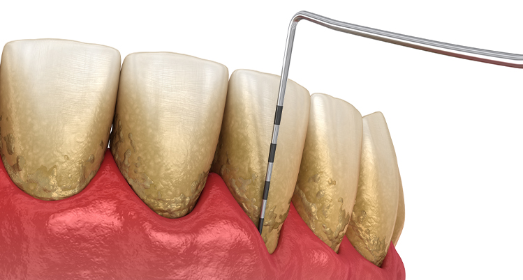 歯周ポケット検査用の器具で汚れ、腫れた歯ぐきを検査するイメージのイラスト