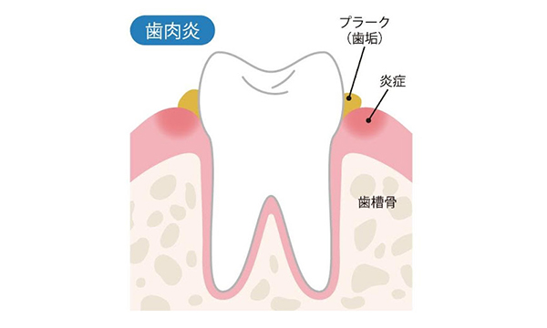 歯肉炎のイメージイラスト