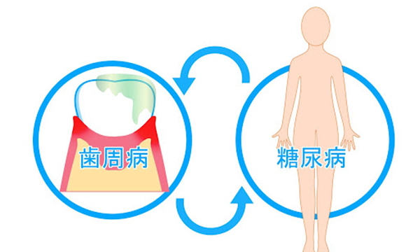 歯周病と糖尿病の関係のイラスト