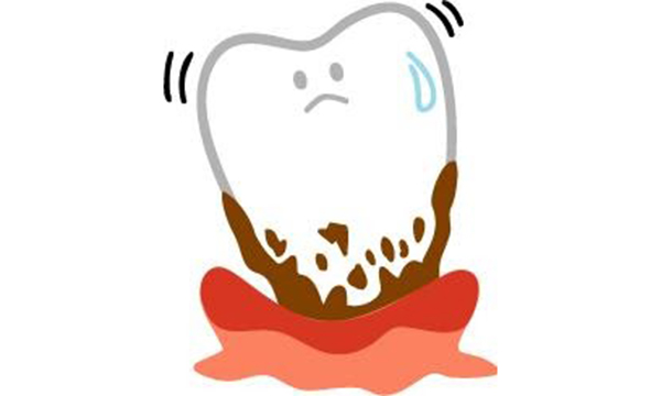 歯周病により揺れが強くなってしまった歯のイメージイラスト