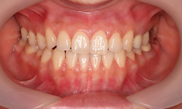 健康な状態の歯ぐきの写真