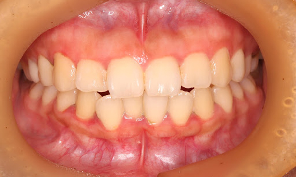 軽度歯周病の歯ぐきの写真