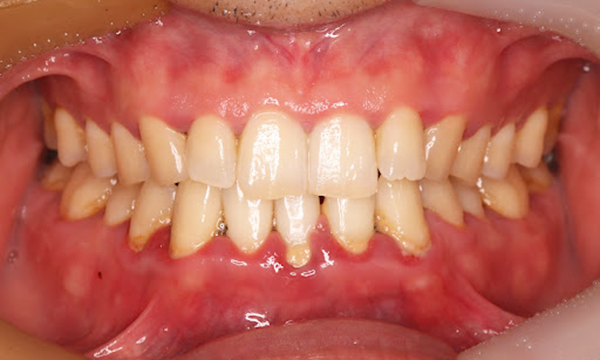 中等度歯周病の歯ぐきの写真