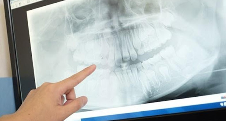 レントゲン画像を指さしている様子の写真