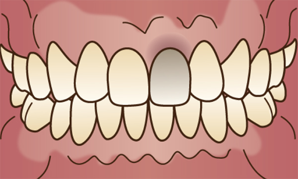 虫歯等により神経を失ってしまった前歯の1本の歯が黒く変色してしまっているイメージイラスト
