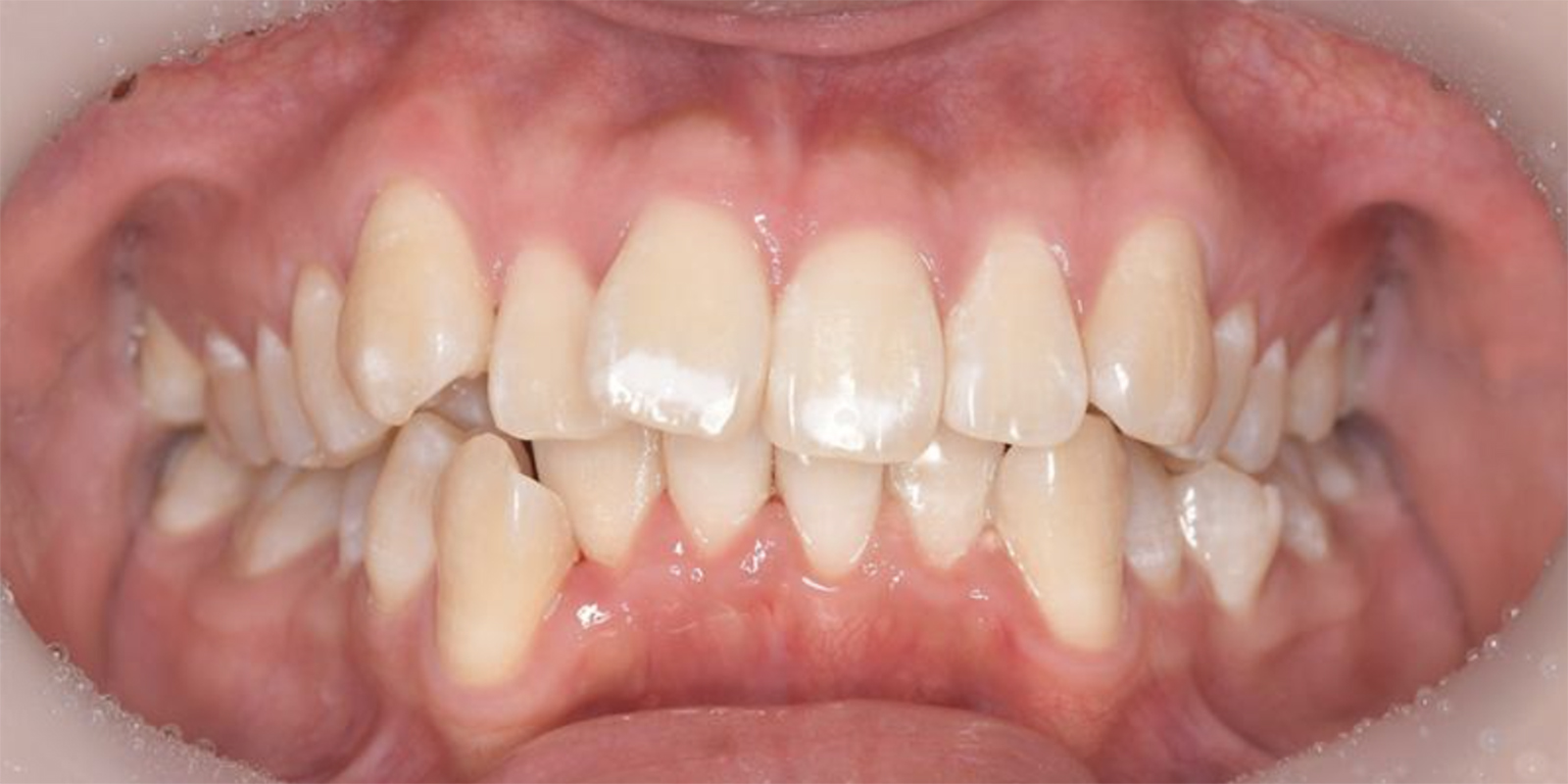 部分的に白い箇所がある歯を写したお口の写真