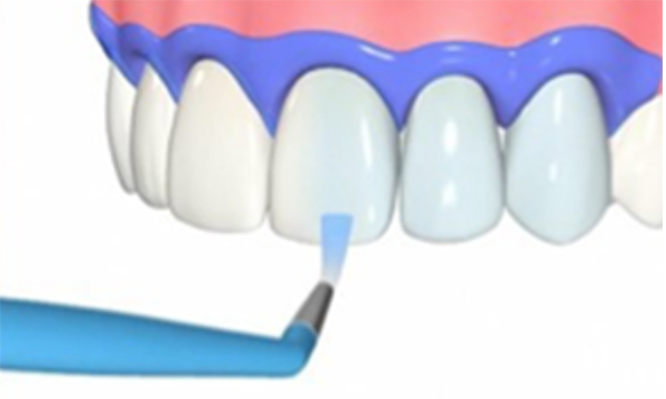 歯ぐきと歯の境目を樹脂の材料で保護し、歯に薬剤を塗布しているイメージ