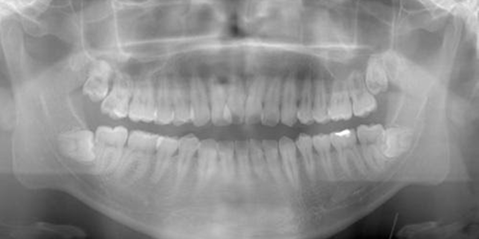 親知らずがあるレントゲン画像