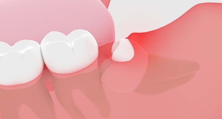 半分頭が出ている親知らずのイラスト