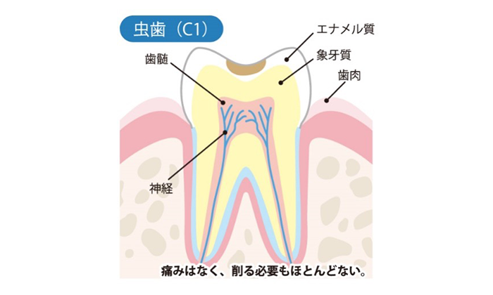 痛みはなく、削る必要もほとんどない歯のイラスト