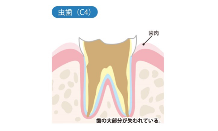 歯の大部分が失われている歯のイラスト