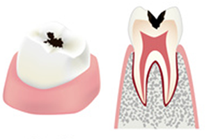 エナメル質を越え、象牙質まで達した虫歯（C2）のイメージ
