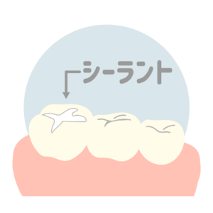 歯の溝を埋めて虫歯予防をするためのシーラントという材料のイラスト