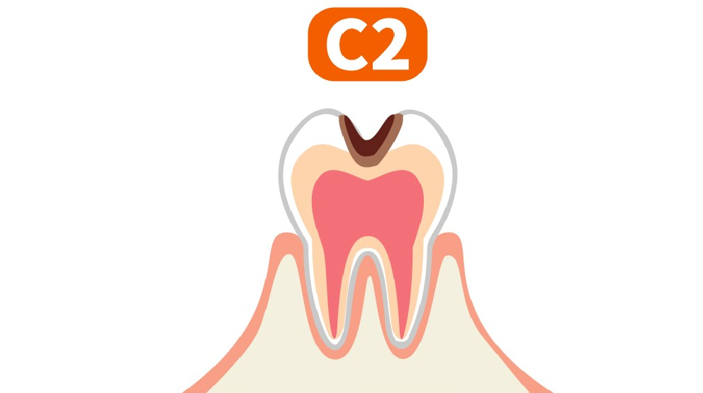 エナメル質を越え、象牙質まで達した虫歯（C2）のイラスト